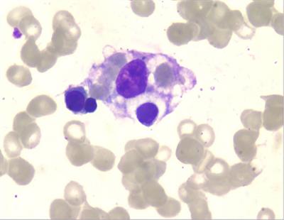 IFN-α induced systemic lupus erythematosus complicated with hemophagocytic lymphohistiocytosis: a case report and literature review